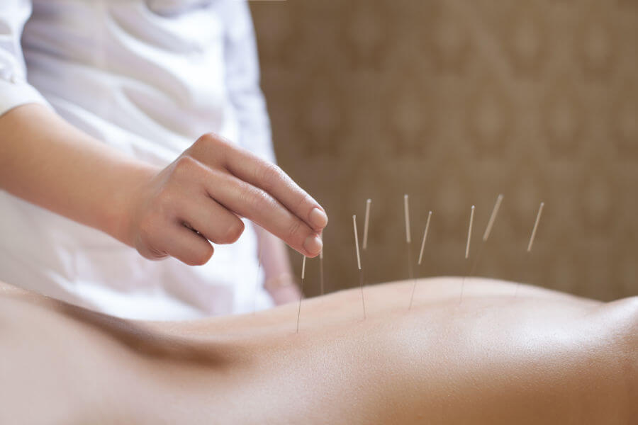 Traditionelle Chinesische Medizin - Akupunktur